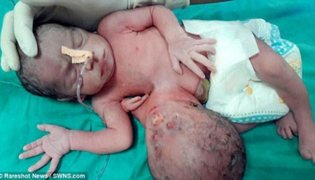 Birth-with-two-heads-India-01
